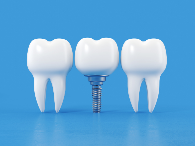 The Role Of Bone Grafting In Dental Implantation