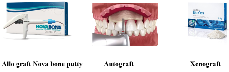 Advances In Bone Grafting Techniques For Dental Implants: A Comprehensive Review