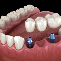 Prosthodontic