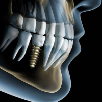 Implantology