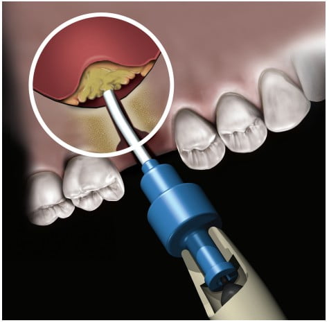 Novabone Putty Cartridge - Single Cartridge of 0.5 cc (Alloplastic graft in PUTTY consistency)