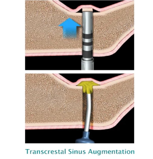 Novabone Putty Cartridges - 4 Cartridge of 0.5 cc (Alloplastic graft in PUTTY consistency)