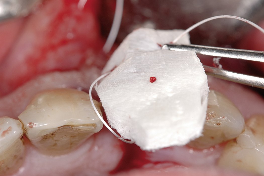 Mucograft 15 x 20 mm (Collagen Matrix) Single Matrix