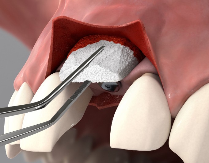 Fibro-Gide 20x40x6 mm (Collagen Matrix) Single Matrix
