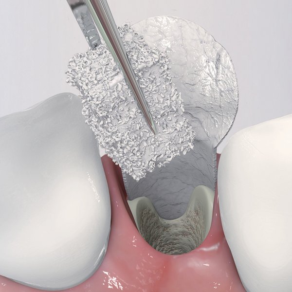 Bio-Gide COMPRESSED 20 x 30 mm (Bi-layered collagen membrane) Singe Unit Pack