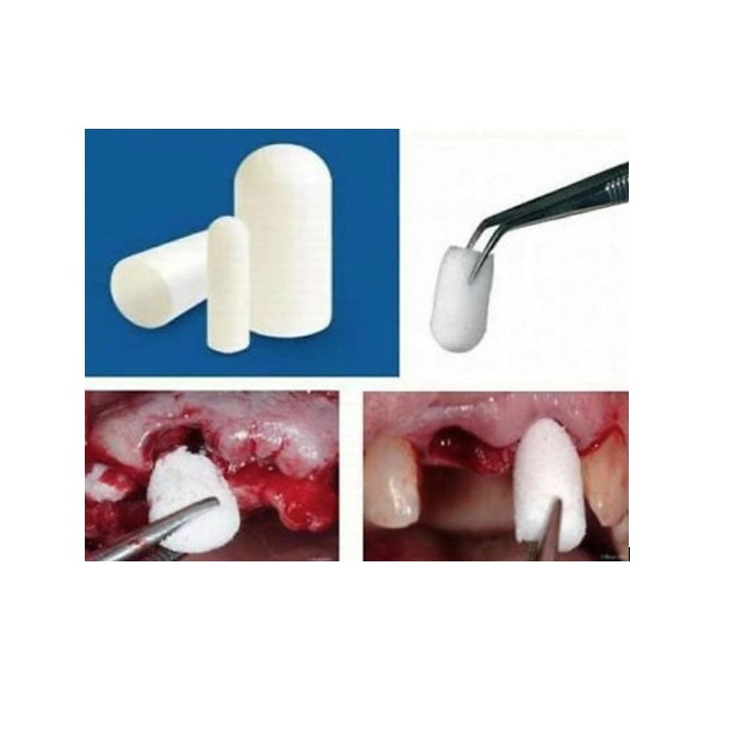 Colo Plug 12 x 20 mm (Sterile Resorbable Collagen Sponge) Single Unit Pack