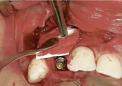 Bio-OSS 0.5 CC Small Granules (0.25-1mm) (0.25g=0.5cc)