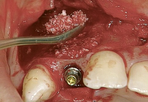 Bio-OSS 0.5 CC Small Granules (0.25-1mm) (0.25g=0.5cc)