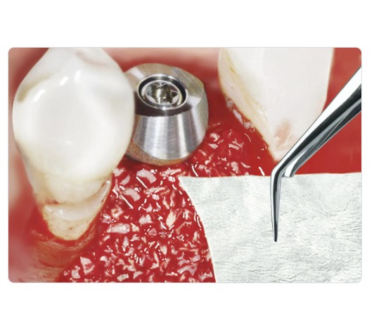 Bio-Gide 25 x 25 mm (Resorbable Bi-layered collagen membrane) Singe Unit Pack