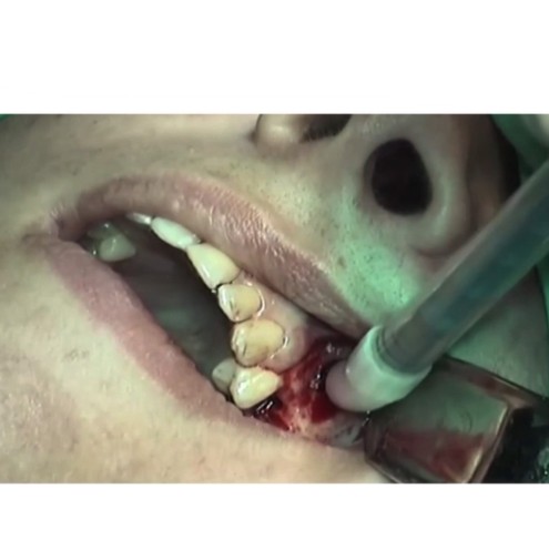 Bio-Oss PEN 1 CC Small granules (pre-filled syringe for guided bone regeneration)