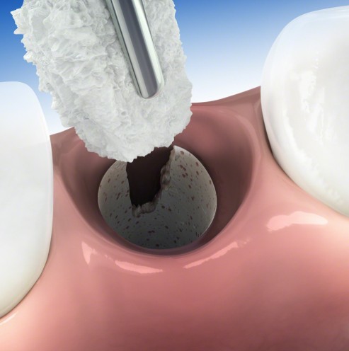 Bio-Oss Collagen 50 MG (Spongious Bone Substitute)