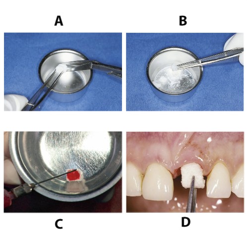 Bio-Oss Collagen 100 MG (Spongious Bone Substitute)