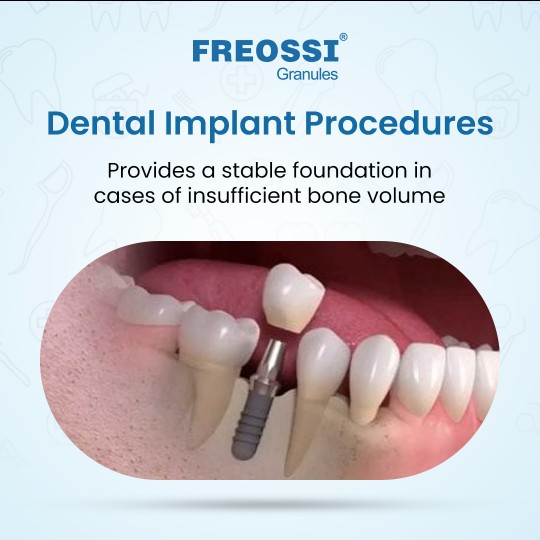 Freossi 0.25 gram = 0.5 cc (0.25 - 1 mm Small particles)  Bone Graft Granules