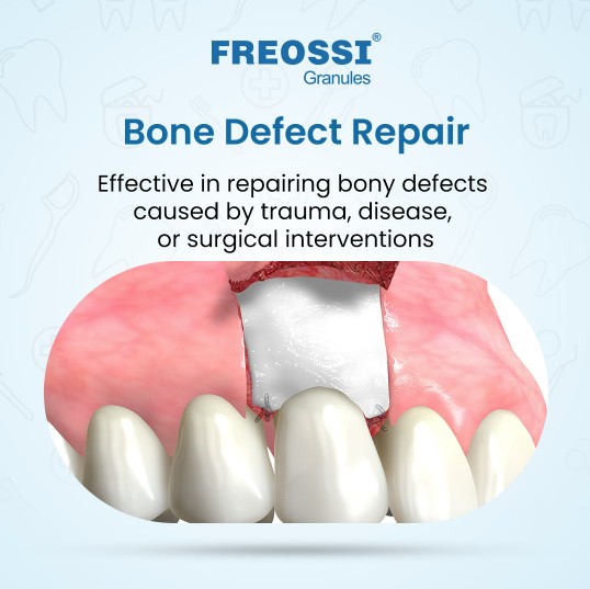 Freossi 0.25 gram = 0.5 cc (0.25 - 1 mm Small particles)  Bone Graft Granules