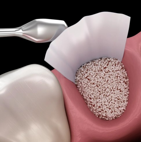 Freossi 0.25 gram = 0.5 cc (0.25 - 1 mm Small particles)  Bone Graft Granules