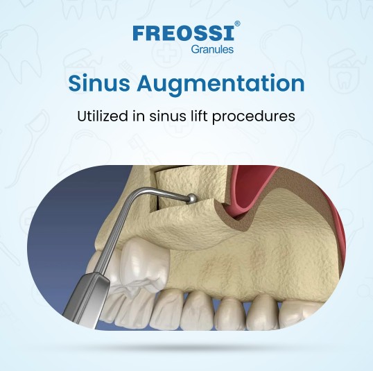 Freossi 0.5 gram = 1.0 cc (0.25 - 1 mm Small particles)  Bone Graft Granules