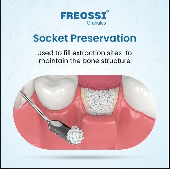 Freossi 0.25 gram = 0.75 cc (1 - 2 mm Large particles)  Bone Graft Granules