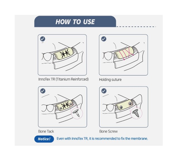Innotex Ti-Reinforced PTFE Membrane 30x40 mm Non-Resorbable (South Korea)