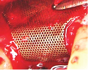 Cytoflex Titanium Mesh 25 x 30 mm (Posterior Small)