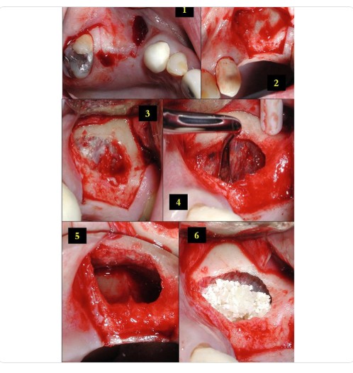 GDC Sinus Lifting Instrument Set Of 8 In Pouch (IMPSLP8)