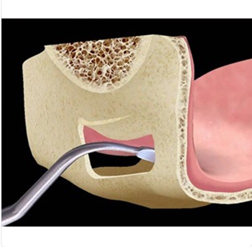 GDC Sinus Lifting Instrument Set Of 8 In Pouch (IMPSLP8)