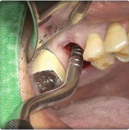 GDC OSTEOTOMES CONCAVE - ANGULATED (Single Instrument)