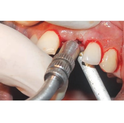 GDC OSTEOTOMES CONVEX - ANGULATED (Single Instrument)
