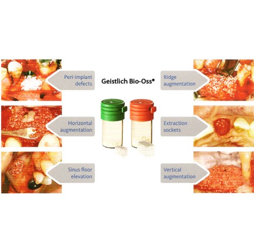 Bio-OSS Bone Graft Granules - All Variants