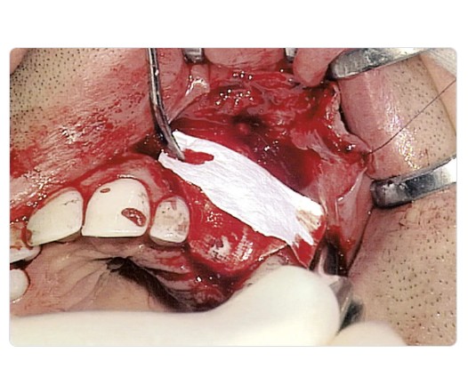 Bio-Gide (Resorbable Bi-layered collagen membrane) - All variants